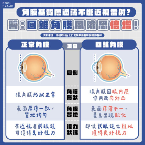 角膜基質層過薄不能近視雷射 圓錐角膜風險恐倍增